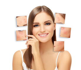 Post-Acne Marks ,Treating Acne Scars.Acne Scar Removal