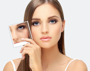 Lower eyelid blepharoplasty.Upper  blepharoplasty.Before and after cosmetic procedures