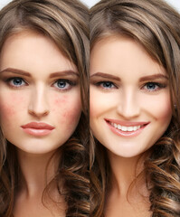 Fototapeta premium Post-Acne Marks /Treating Acne Scars