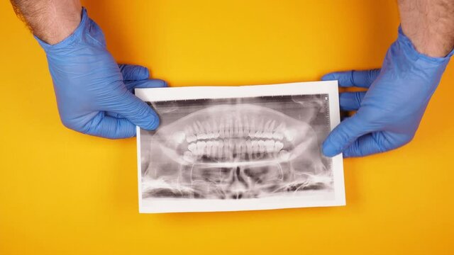 The hands of a male orthodontist doctor in blue rubber gloves are holding a picture of the teeth and examining it on a bright yellow background