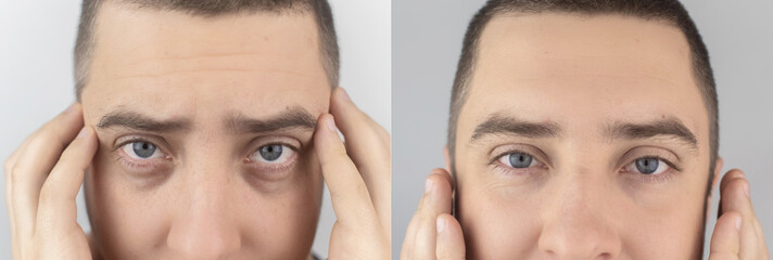 Before and after. Bags under eyes, hernias on the man face. Patient being examined by a plastic...