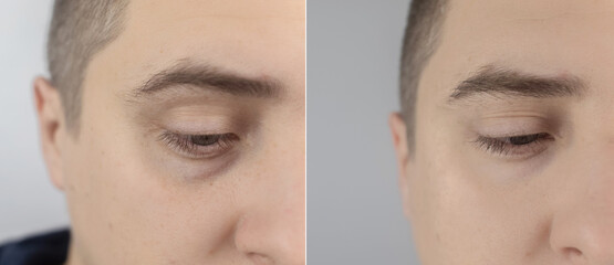 Before and after. Bags under eyes, hernias on the man face. Patient being examined by a plastic...