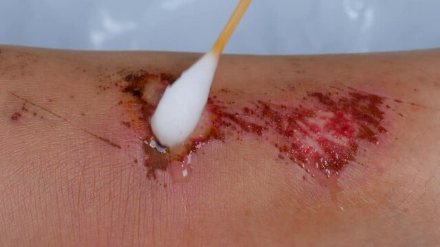 close up doctor cleaning wound on the leg, Injuries from falling