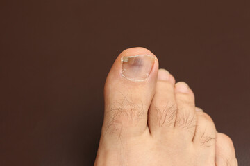 foot of a person with a sick nail fungi infection