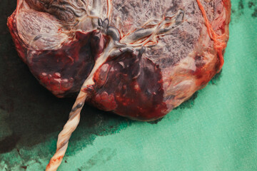 Fototapeta na wymiar Placenta and umbilical cord
