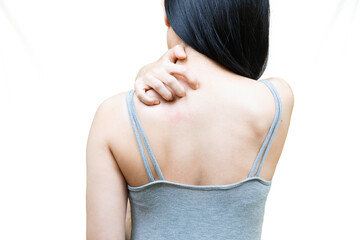 woman hand scratching her skin itchy because of allergy to hot weather.Itching behind the plate on a white background
