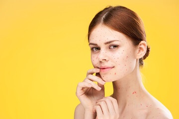 woman with bare shoulders red dots on her face health problems dermatology