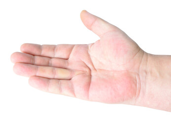 Dupuytren's contracture, also called Dupuytren's disease, Morbus Dupuytren, Viking disease, and Celtic hand. On white background.