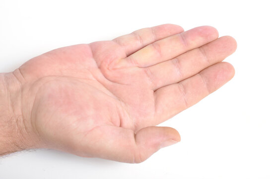 Dupuytren's contracture, also called Dupuytren's disease, Morbus Dupuytren, Viking disease, and Celtic hand. On white background.