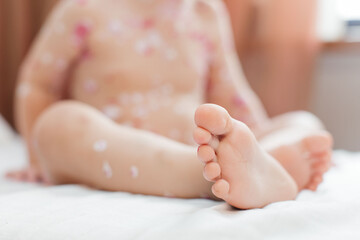 Children's legs with chickenpox. Close-up of the legs. bare children's feet on white