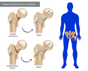 Repair of Hip Fracture or Fixation. Intertrochanteric fracture or Femoral neck fracture. Broken Hip - obrazy, fototapety, plakaty