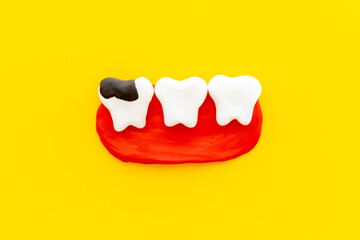 Oral health concept. Healthy and caries teeth models on gums
