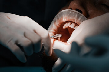 close-up of the process of implantation of teeth and tooth in a dental clinic operation

