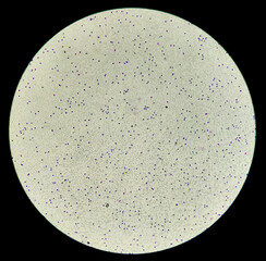 Blood smear leishman stained Microscopic 10x show Acute lymphocytic leukemia (ALL). A cancer of...