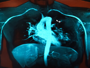 CT scan of heart and chest wall showing normal heart, lungs, artery and vessel. No myocardial infarction or pneumonia sign.