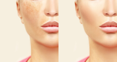 Dark spots, freckles,hyperpigmentation(melasma or chloasma).