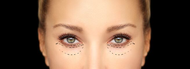 Lower and upper  Blepharoplasty.Marking the face.Perforation lines on females face, plastic surgery...