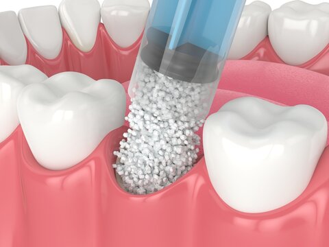 3D render of dental bone grafting with dental bone biomaterial application