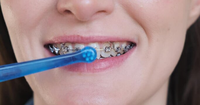 Woman brushing braces with monobunched toothbrush, close-up. Cropped smiling woman face with metal brackets on teeth. Orthodontic oral care, treatment, dental hygiene. Cleaning self-ligating braces