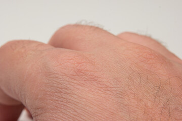 Caucasian male hand with black hair follicles macro close up shot