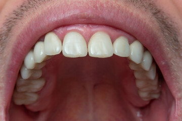 Caucasian male opened mouth close up macro shot. Row of with teeth, visible oral cavity,...