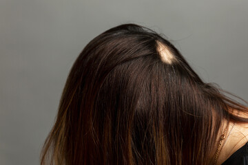 Alopecia on the woman's head. The area without hair in a brunette. Stress and cosmetology. Gray background. Close-up.