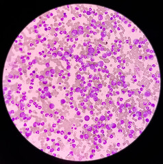 Blood cancer. Chronic myelogenous leukemia, also known as Chronic myeloid leukemia(CML) with Thrombocytosis.