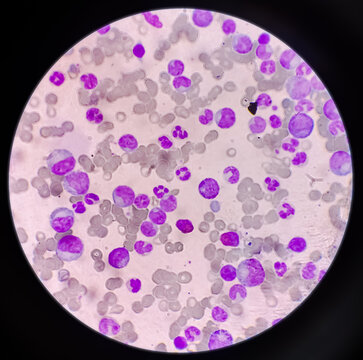 Blood cancer. Chronic myelogenous leukemia, also known as Chronic myeloid leukemia(CML) with Thrombocytosis.