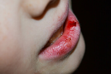 Obraz premium Dry and damaged lips of a girl.