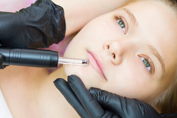 The cosmetologist makes microinjections, takes care of the patient with a leather pen. Lip augmentation is painless, without injections. hyaluronic pen