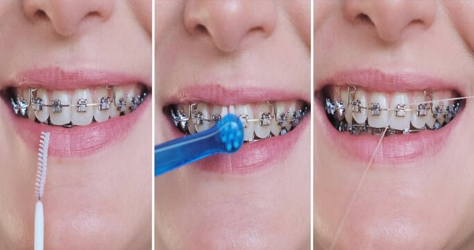 Collage cleaning braces teeth system, close-up. Oral care concept with braces. Woman brushing metal brackets by orthodontic toothbrushes, dental floss, monobuched brush. Healthcare hygiene
