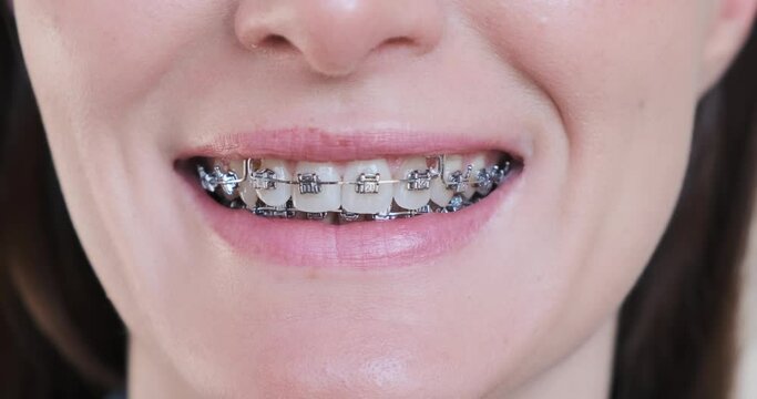 Female smile with metal braces teeth, close-up. Beautiful caucasian woman smiling with white teeth, dental self-ligating braces. Orthodontic treatment. Happy girl cropped face with brackets mouth