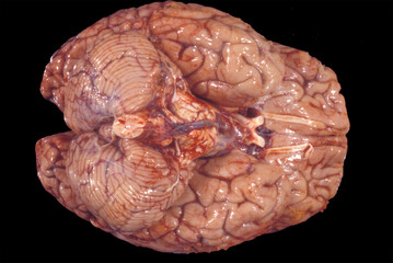 Human brain Subarachnoid basal hemorrhage - obrazy, fototapety, plakaty