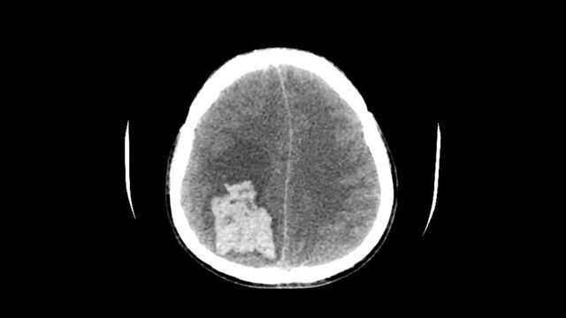 Head Ct Scan Of Intra Cerebral Hemorrhage 