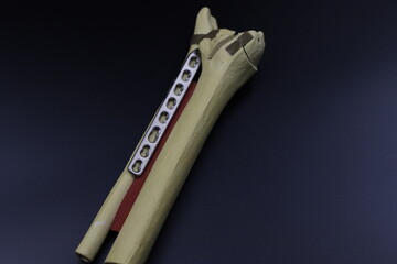 Surgical plates for osteosynthesis in case of operation  bone fractures