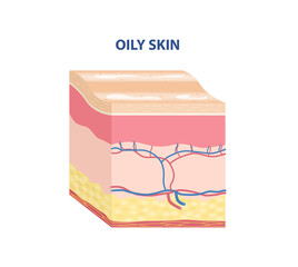 Skin Type Sticker. Colorful icon with layers of skin. Oily epidermis. Sebaceous glands. Design element for cosmetology magazines. Cartoon isometric vector illustration isolated on white background