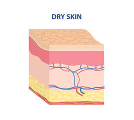 Skin Type Sticker. Dry skin. Layers with cracked dermis from lack of moisture. Design element for scientific websites and apps. Cartoon isometric vector illustration isolated on white background
