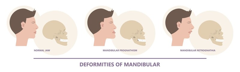 Jaw Surgery chin implant Sleep Apnea snoring upper airway plastic facial Cranio TMD TMJ joint Overbite teeth dental birth defects Open bite pain trauma cosmetic gummy smile bone reconstructive bad