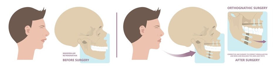 Jaw Surgery chin implant Sleep Apnea snoring upper airway plastic facial Cranio TMD TMJ joint Overbite teeth dental birth defects Open bite pain trauma cosmetic gummy smile bone reconstructive bad