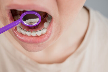 Close-up portrait of a woman with internal braces and a dental mirror. The girl corrects the bite