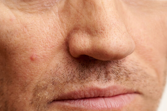 Close-up face of mature man with problem skin.