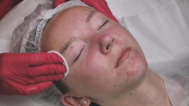 Wipe the mask off the face of a girl with problematic koja with cotton pads.