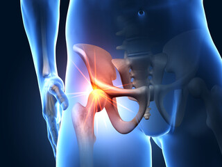 Painful hip joint, medical 3D illustration - obrazy, fototapety, plakaty