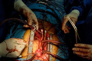 Surgeons during surgery in operation room using all equipment necessary to have a successful surgery