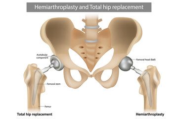 Total hip replacement components and Hemiarthroplasty. Implant - obrazy, fototapety, plakaty