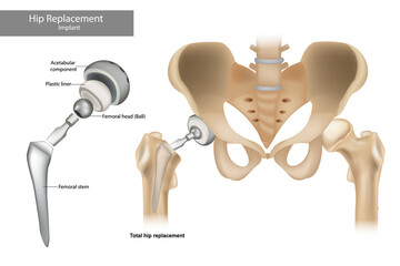 Total hip replacement components. Hip Implant. - obrazy, fototapety, plakaty