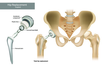 Total hip replacement components and Hemiarthroplasty. Hip Implant - obrazy, fototapety, plakaty