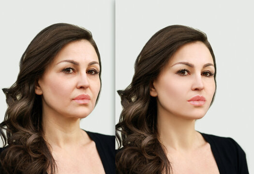 Aging. Mature woman-young woman.Face with skin problem.Showing photos before and after.