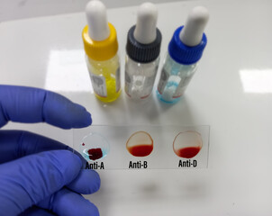 Blood group testing by slide agglutination method with reagent, A Negative blood grouping. medical...