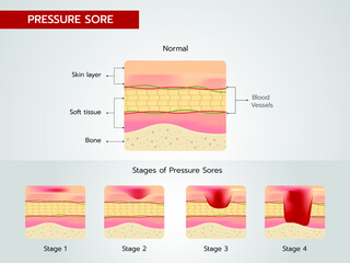 Bedsores Pressure Ulcers Stages of Pressure Sores - obrazy, fototapety, plakaty
